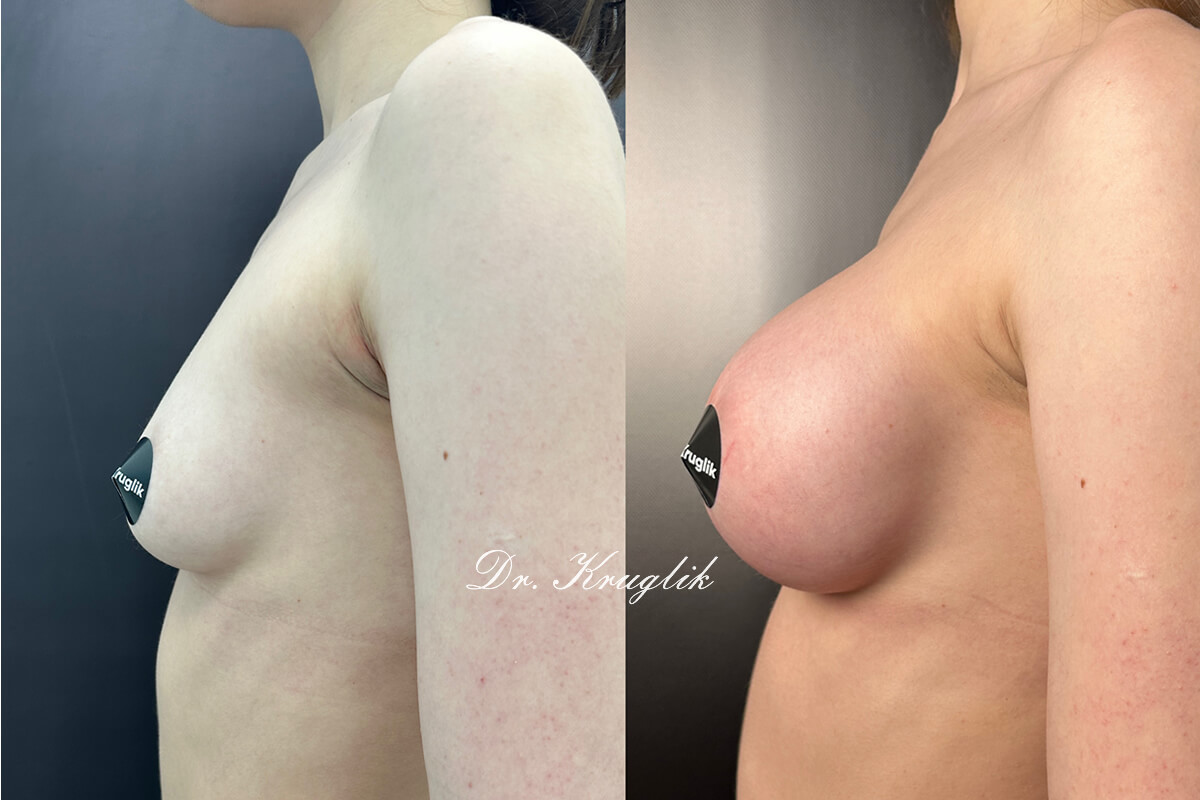 Увеличение груди имплантами 01