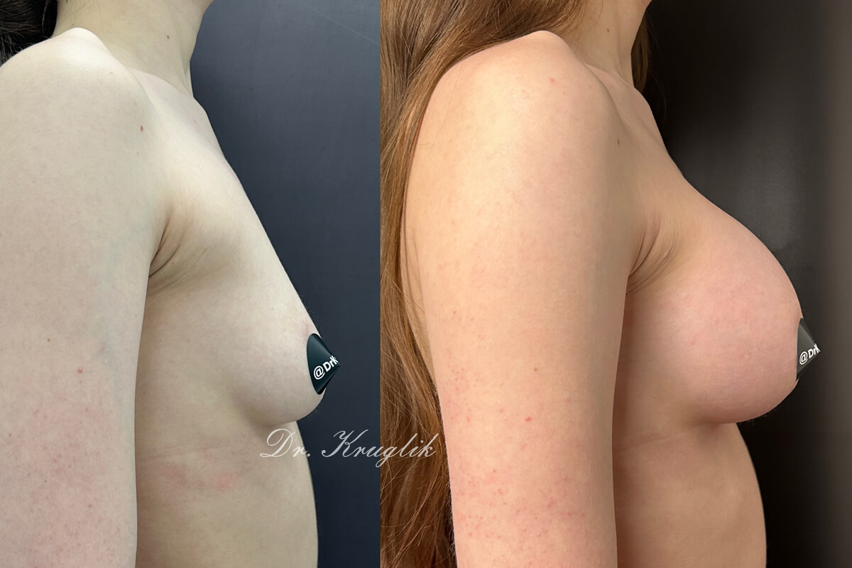 Увеличение груди имплантами 01