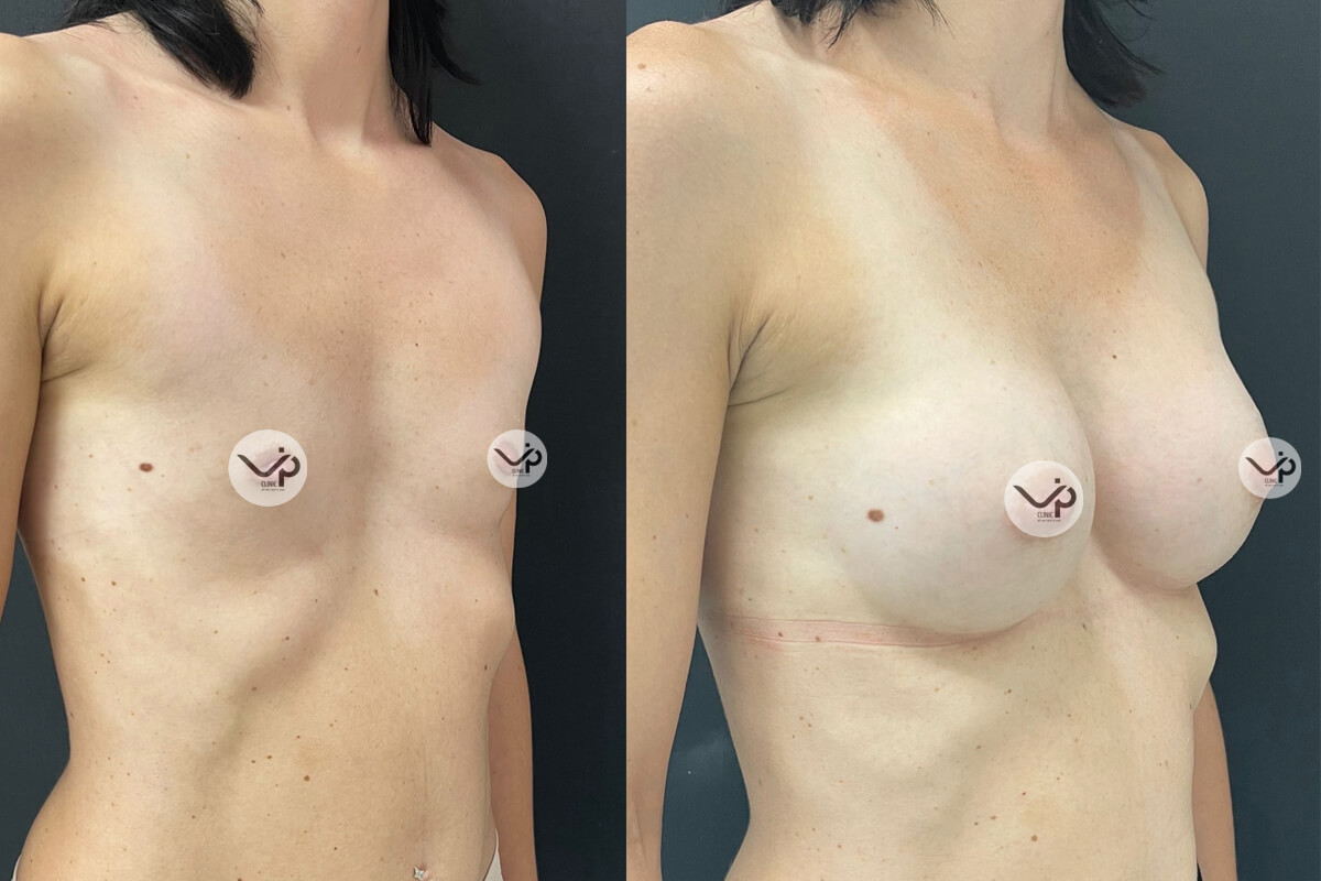 Увеличение груди имплантами 01