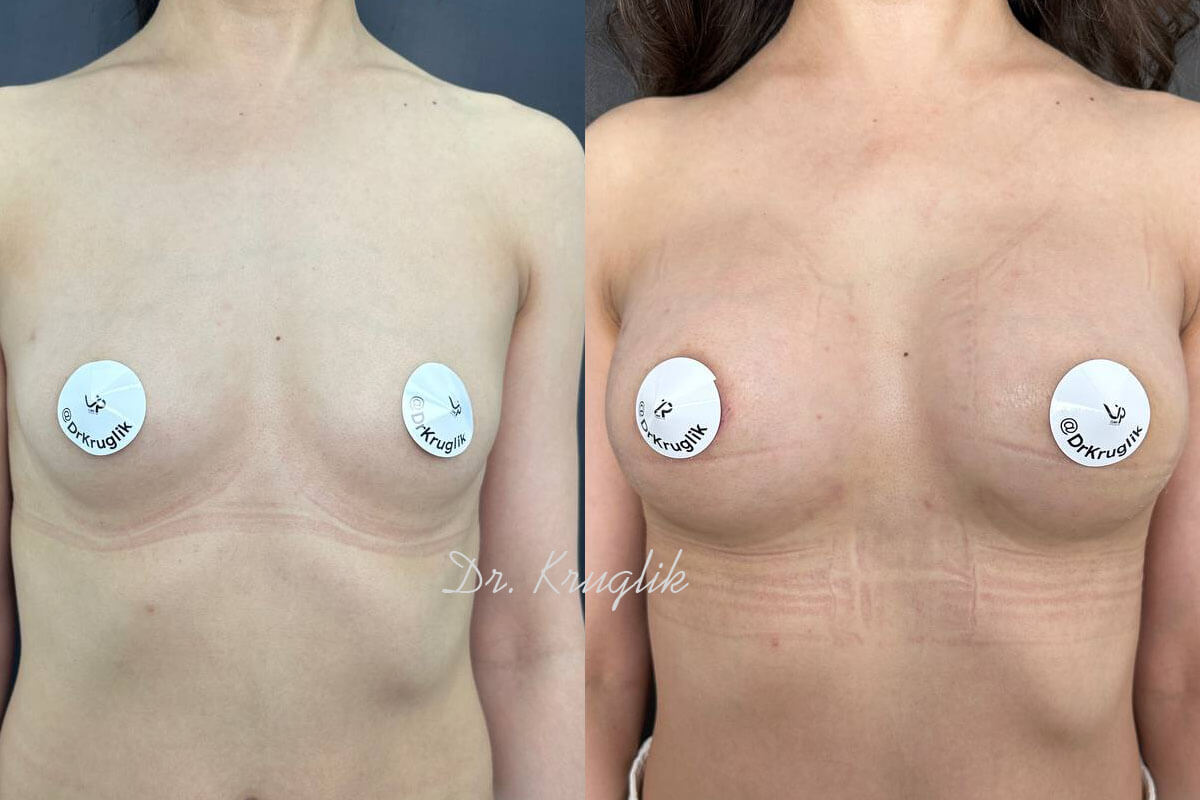 Увеличение груди имплантами 01