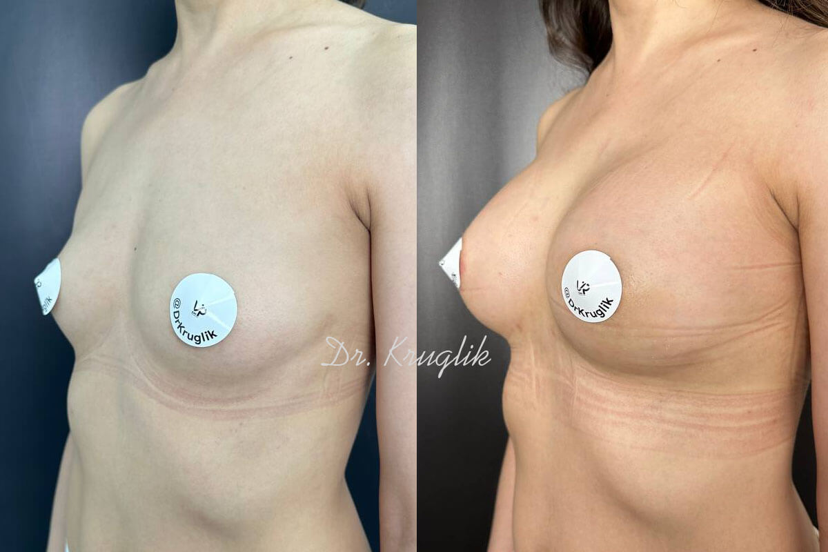 Увеличение груди имплантами 01