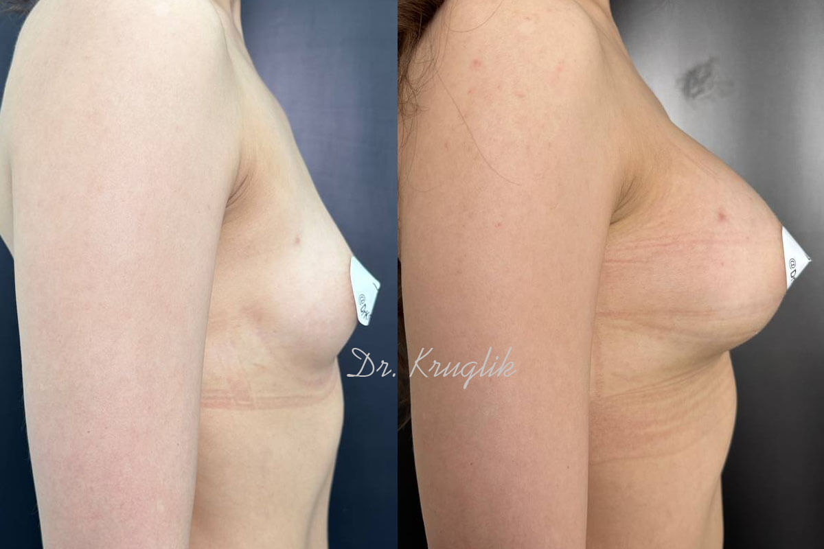 Увеличение груди имплантами 01