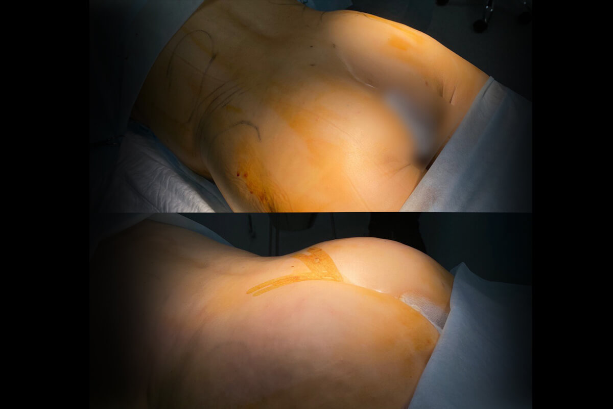 Увеличение ягодиц имплантами 01