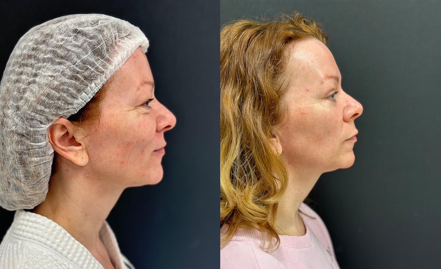 Нижняя блефаропластика 01