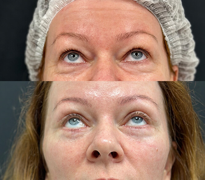 Нижняя блефаропластика 01