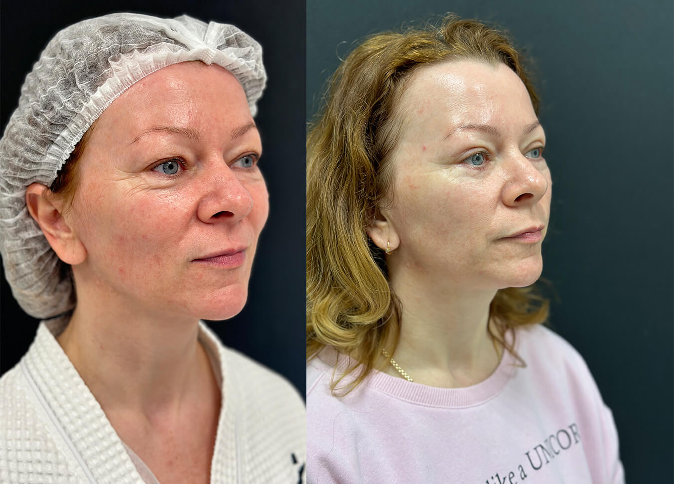 Нижняя блефаропластика 01