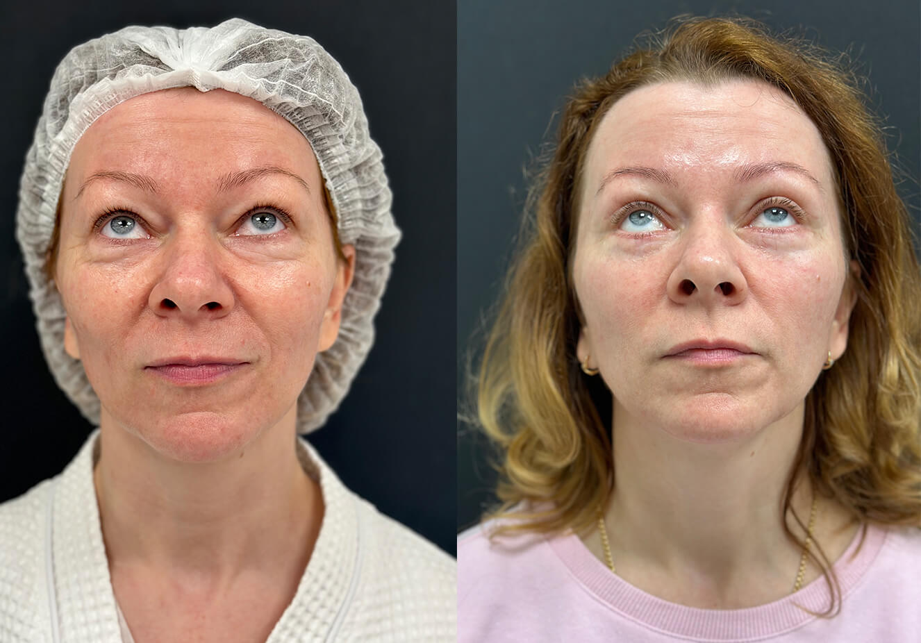 Нижняя блефаропластика 01