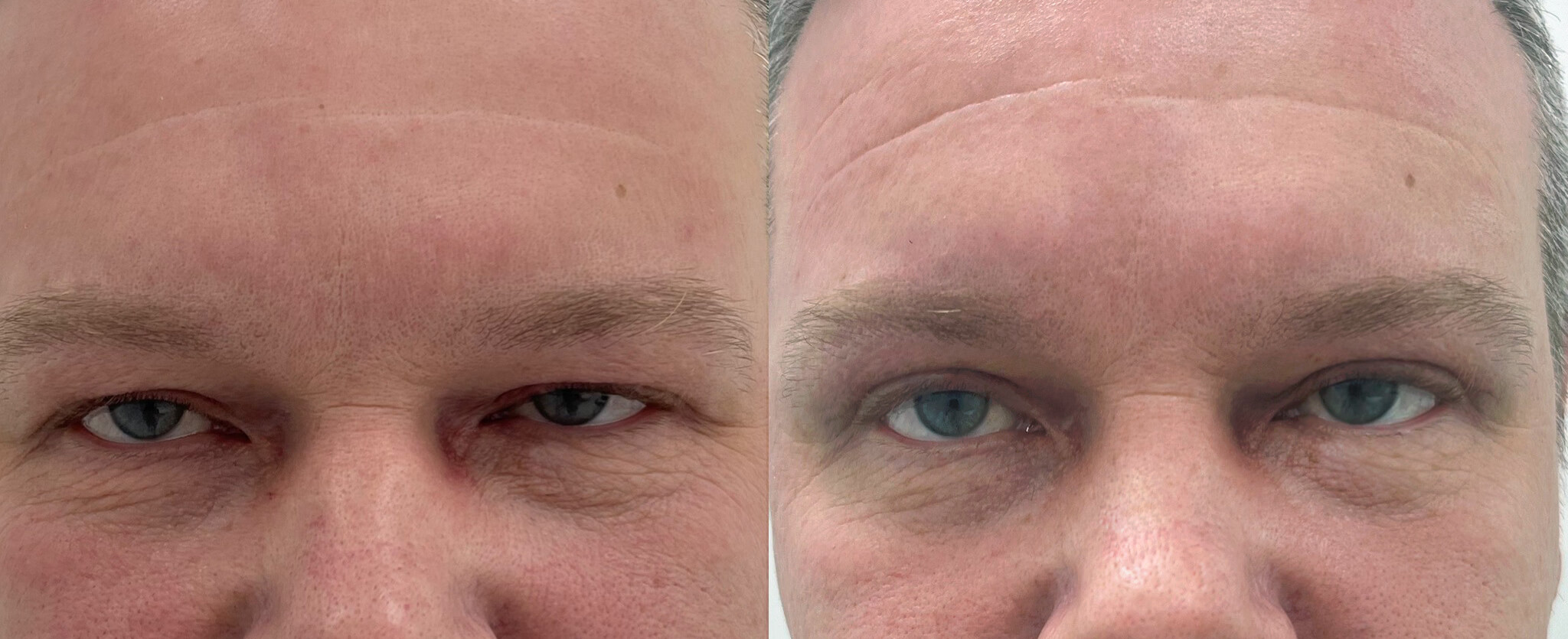 Нижняя блефаропластика 01