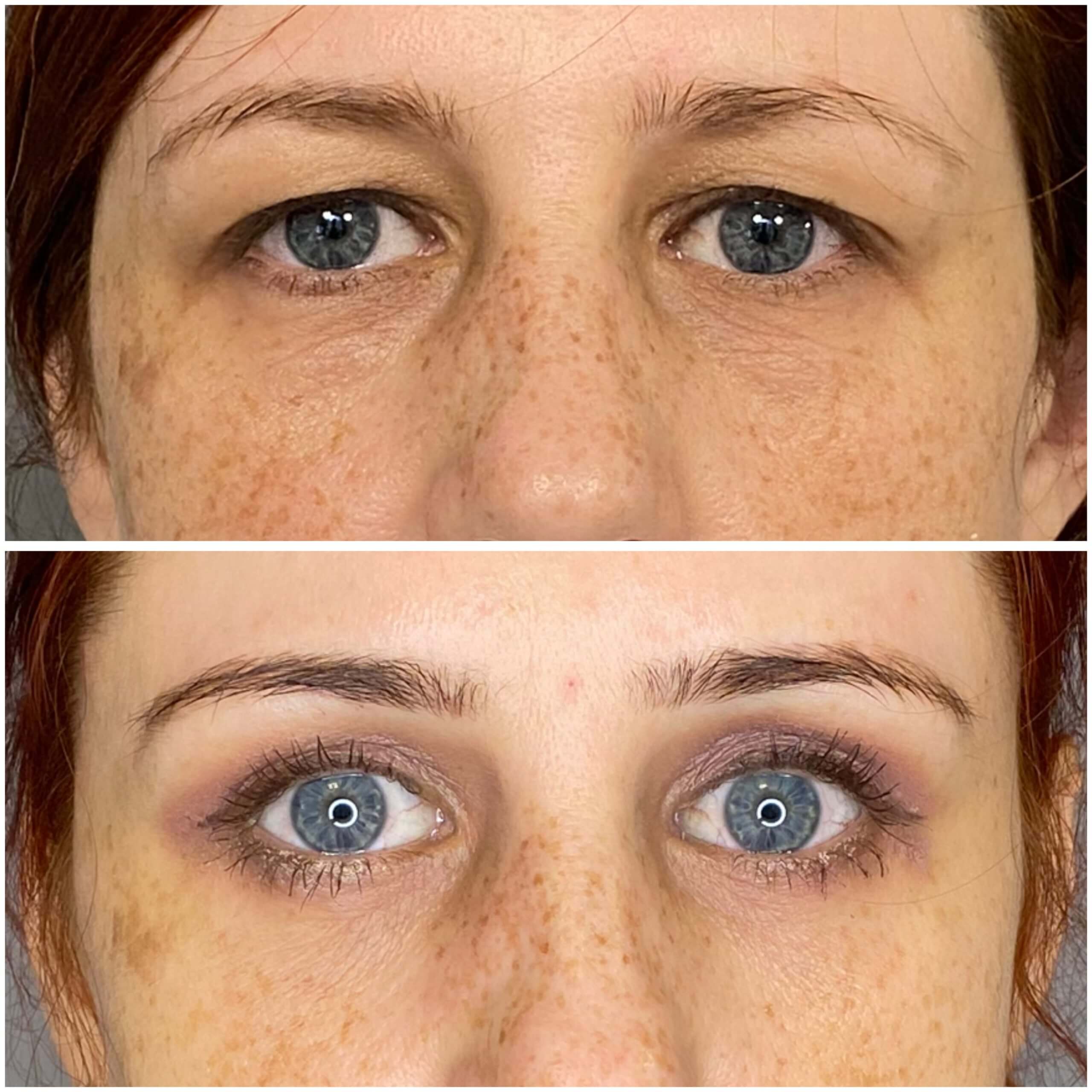 Нижняя блефаропластика 01