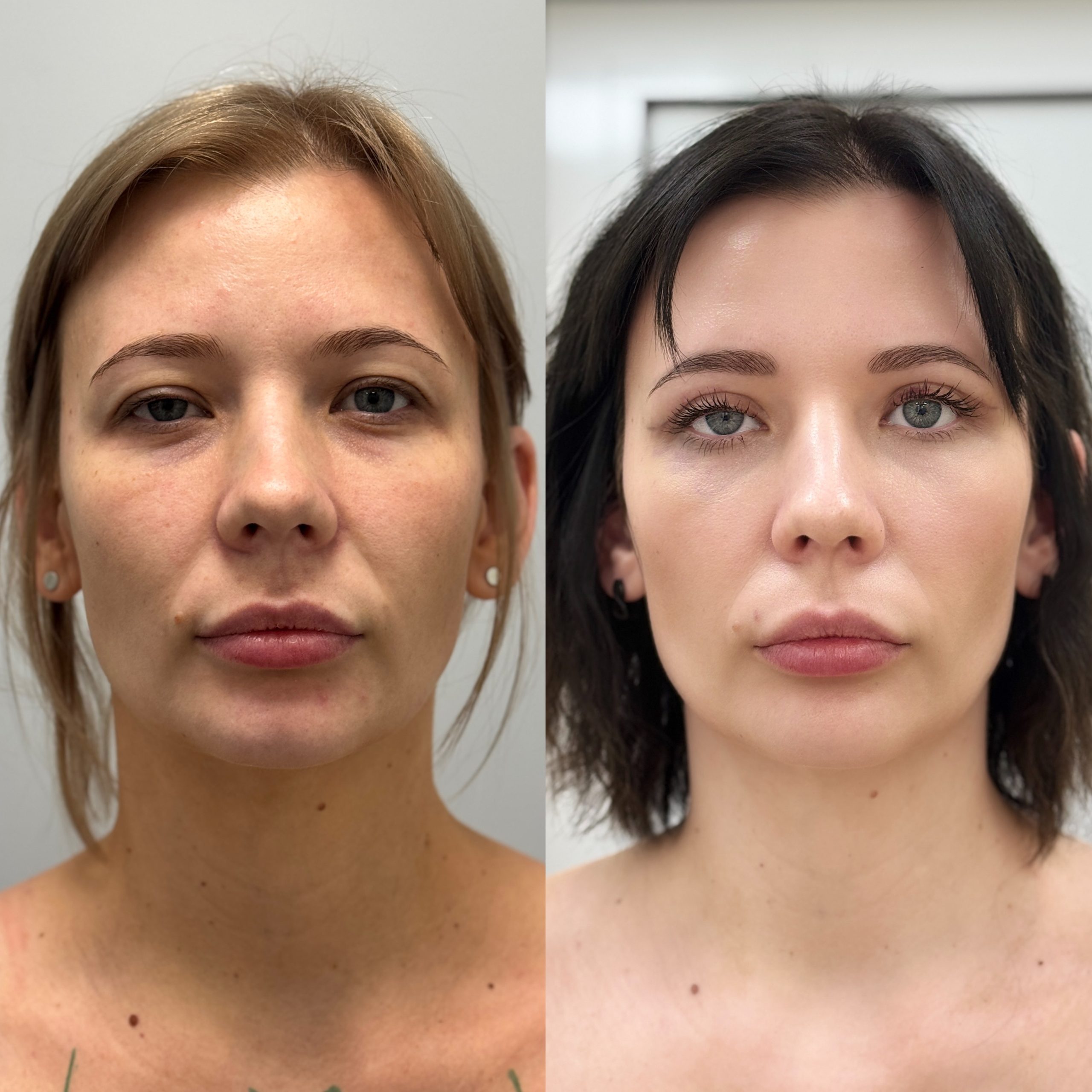 Нижняя блефаропластика 01