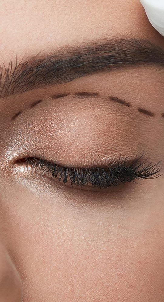 Верхняя блефаропластика