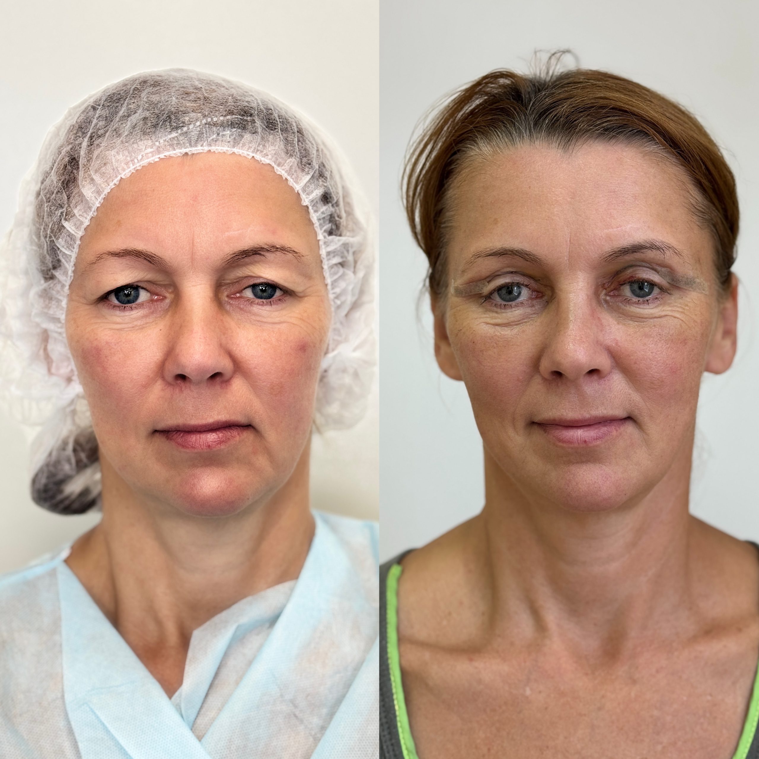 Нижняя блефаропластика 01