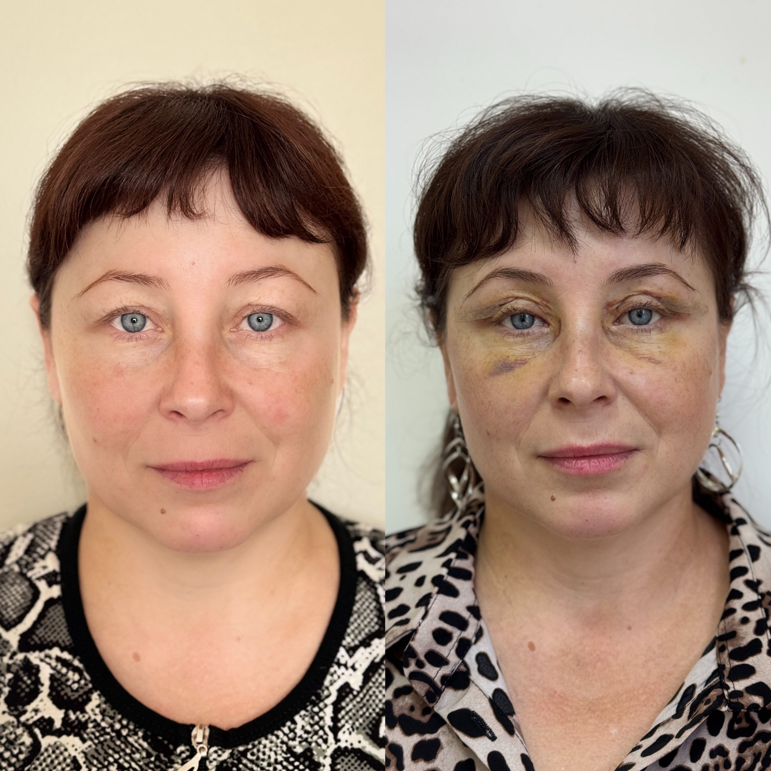 Нижняя блефаропластика 01