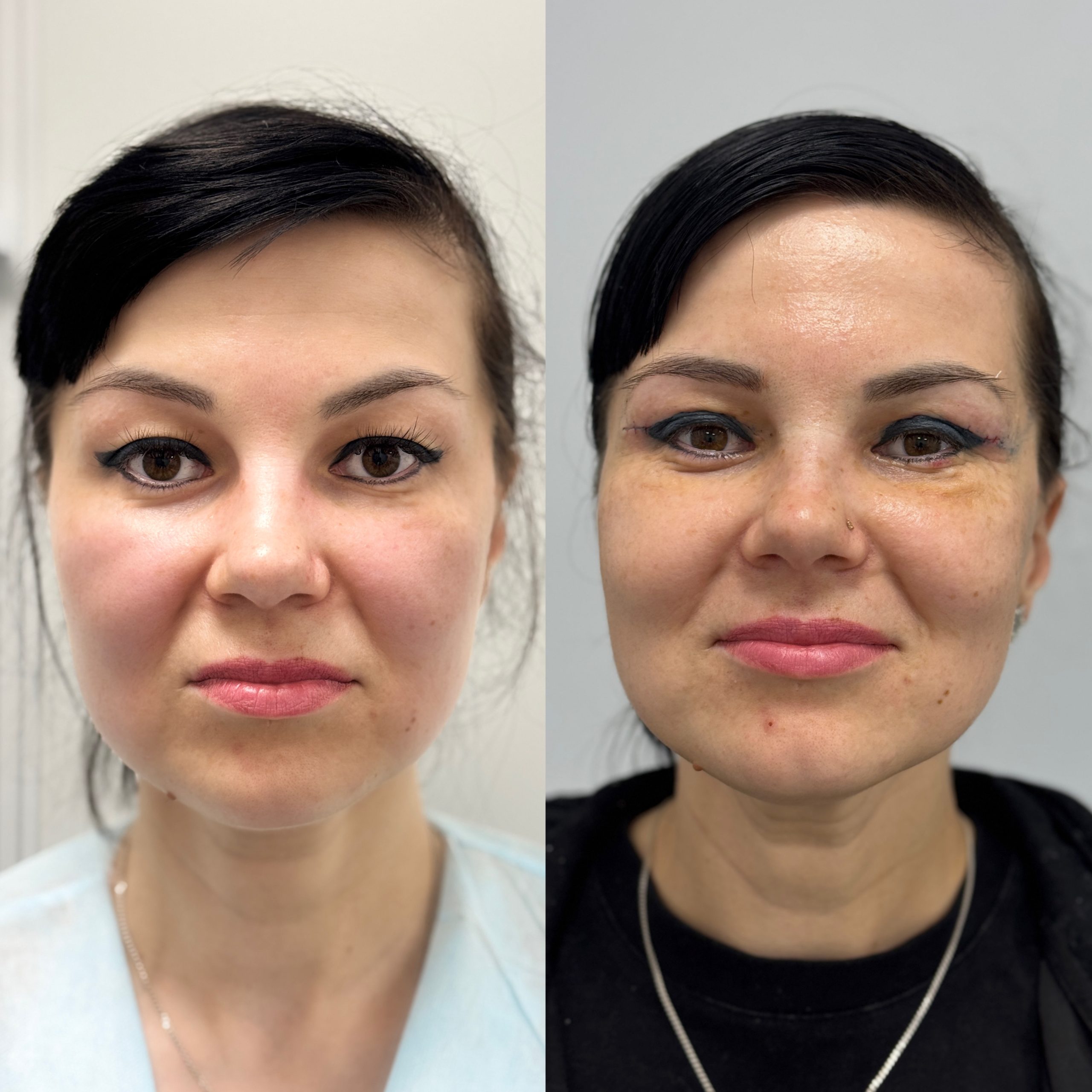 Нижняя блефаропластика 01