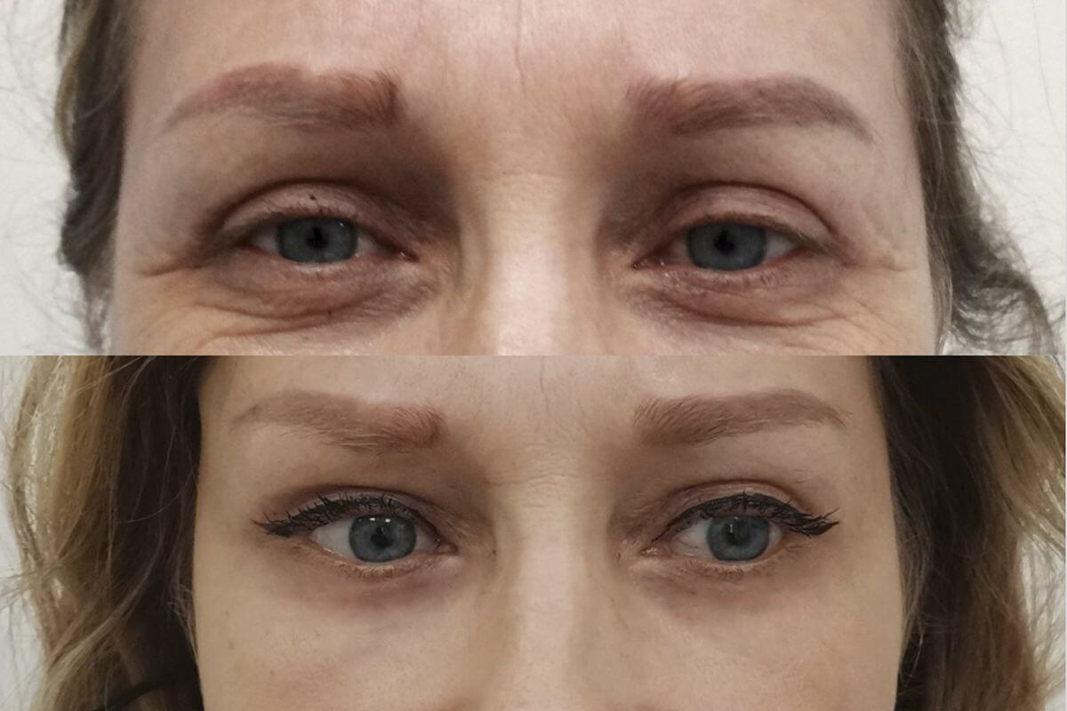 Нижняя блефаропластика 01