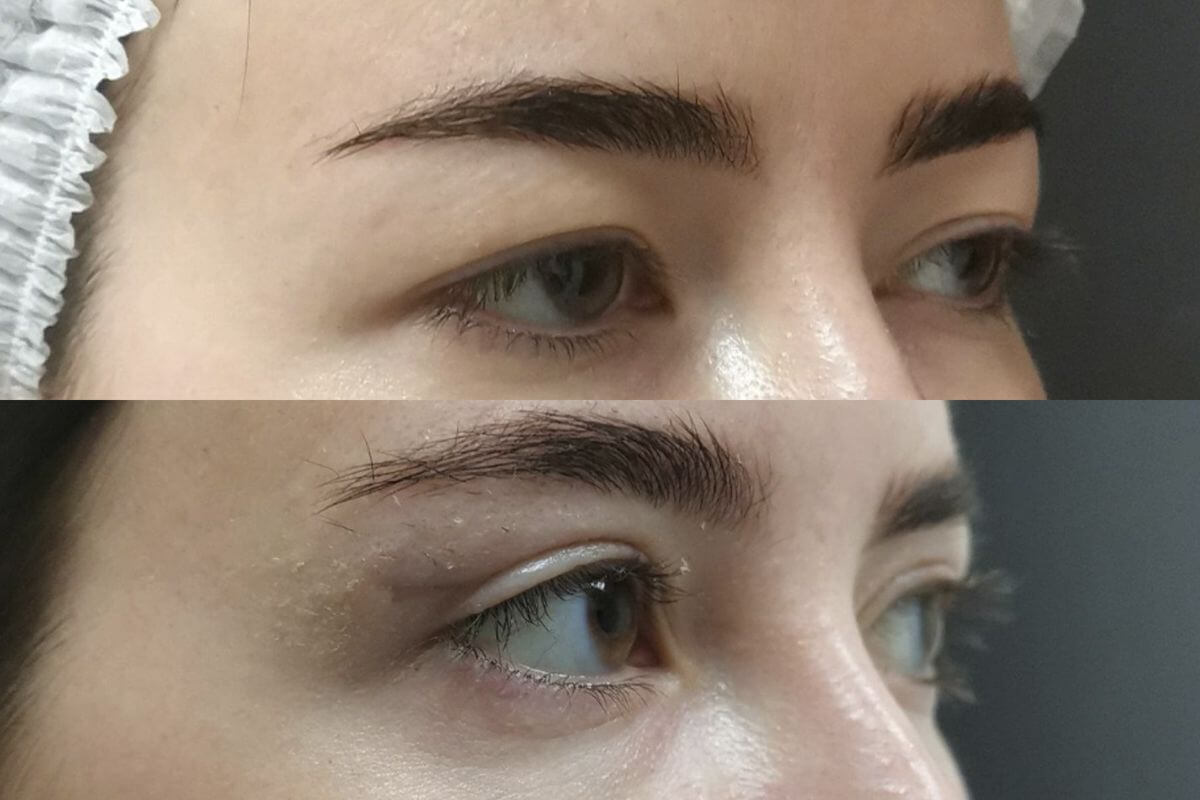 Нижняя блефаропластика 01