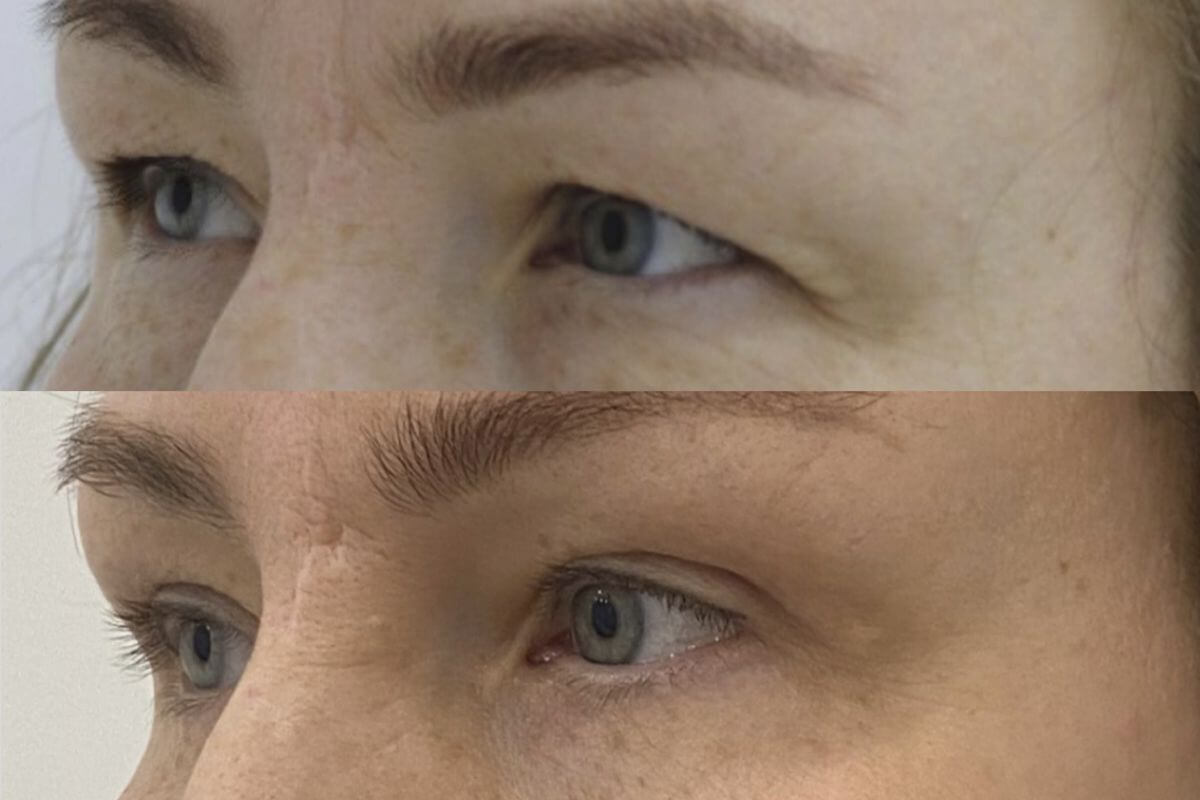 Нижняя блефаропластика 01