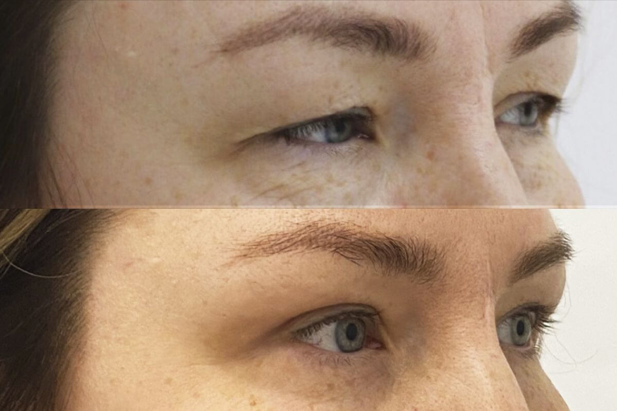 Нижняя блефаропластика 01