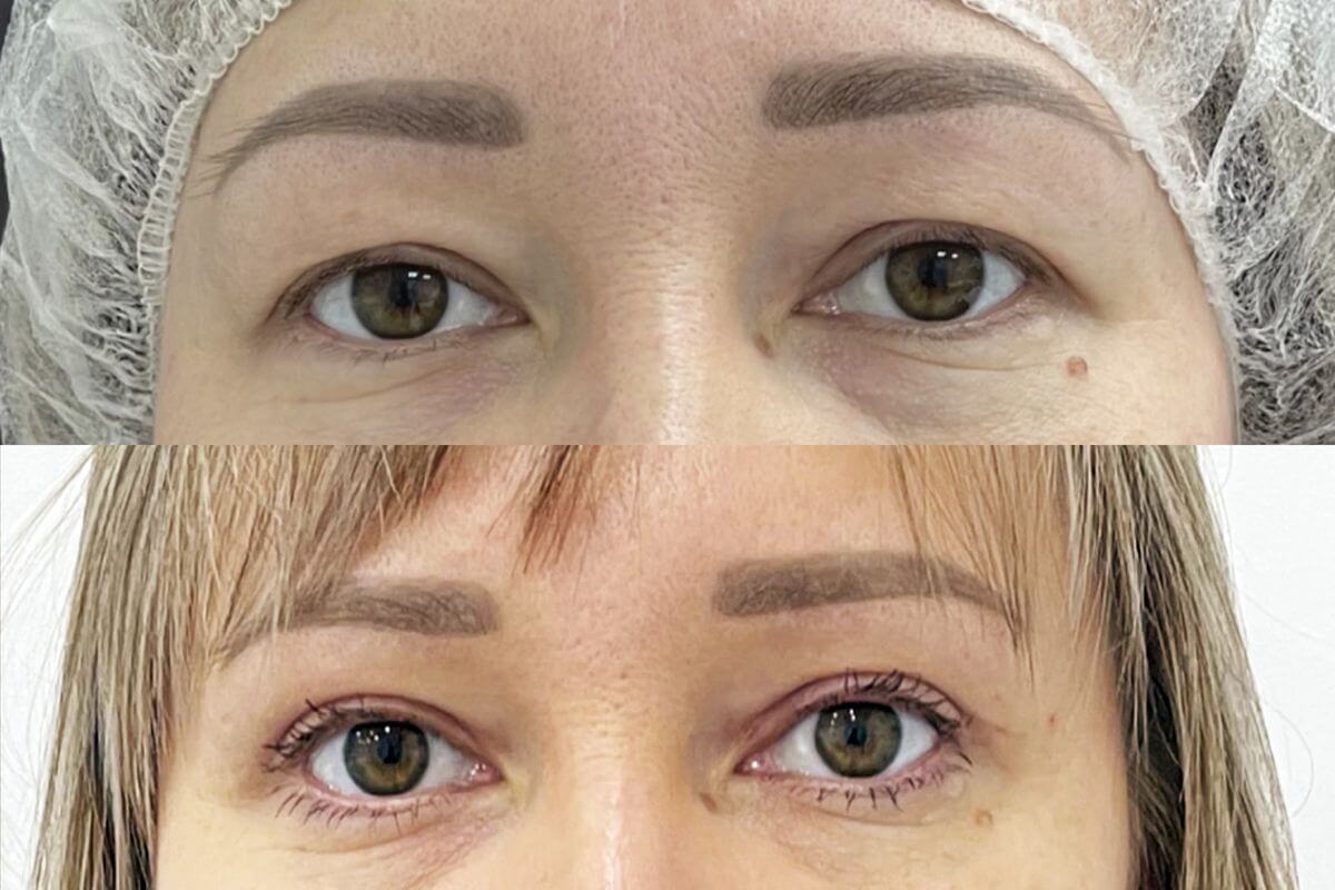 Нижняя блефаропластика 01