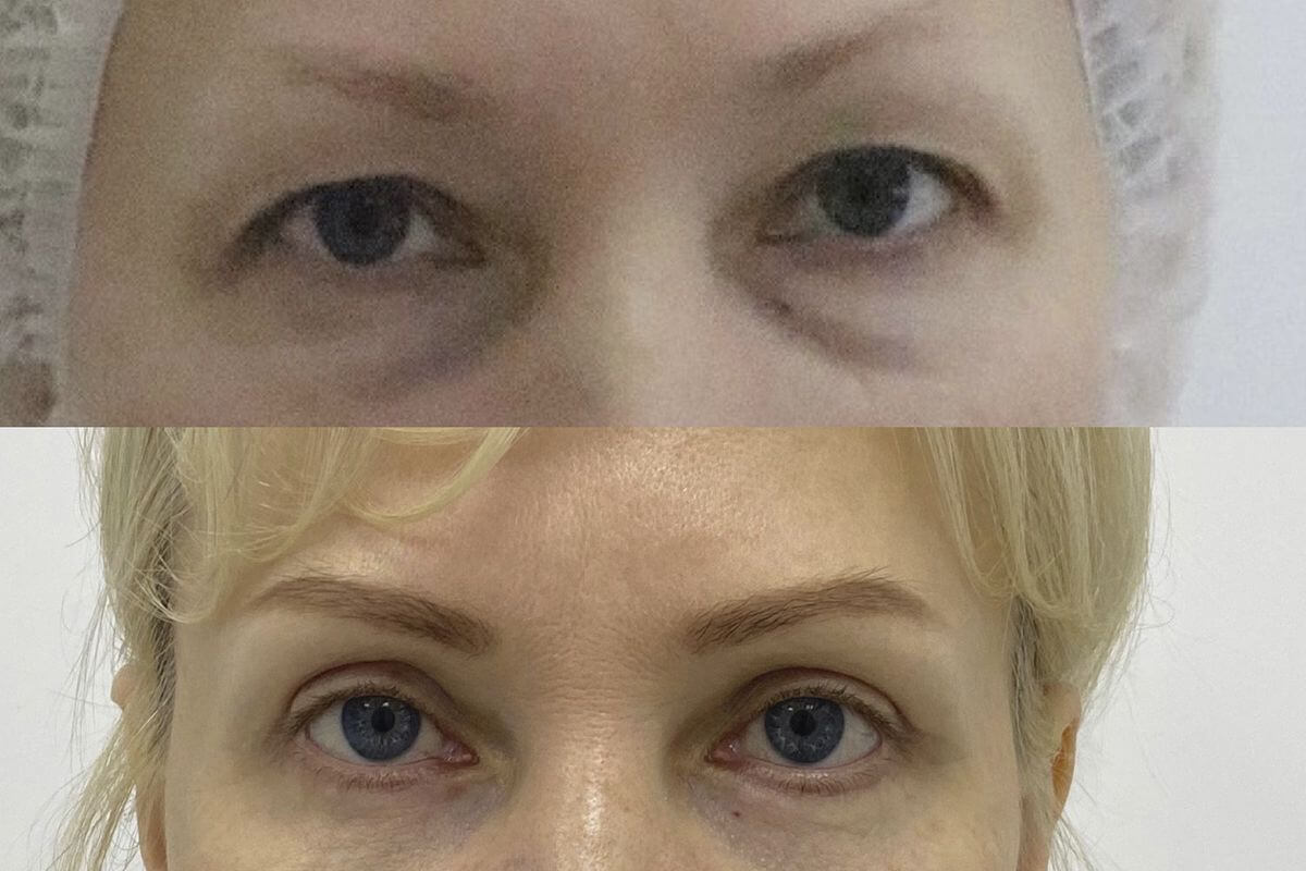 Нижняя блефаропластика 01