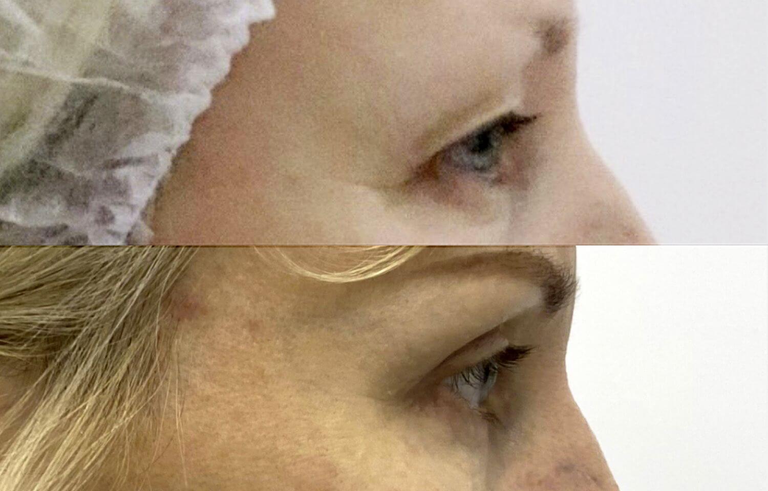 Нижняя блефаропластика 01