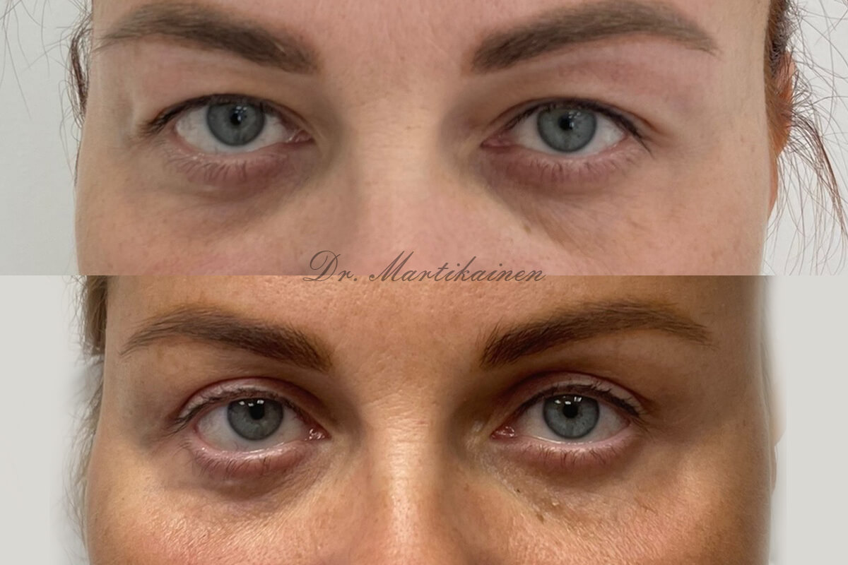 Нижняя блефаропластика 01