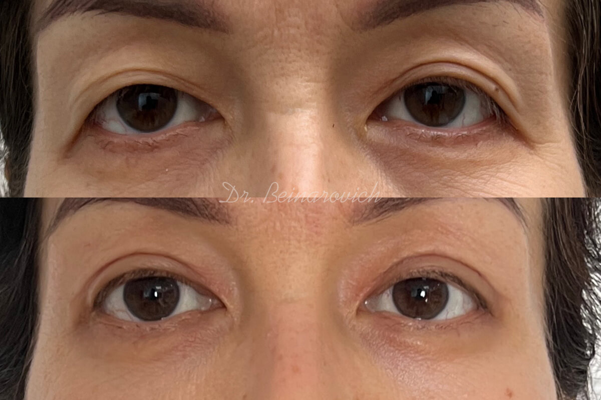 Нижняя блефаропластика 01