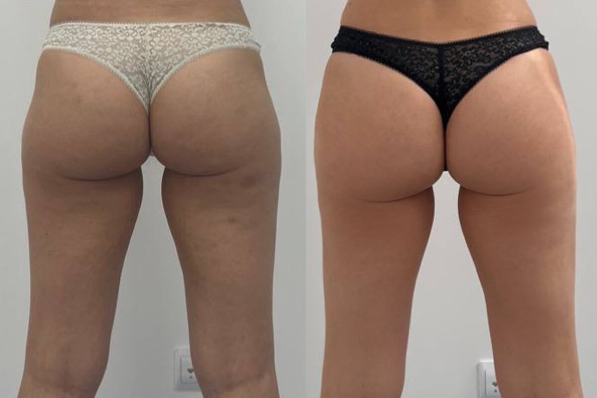 Аппарат EVOLVE 01