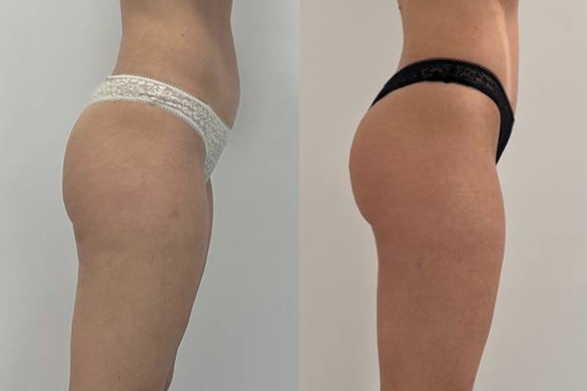 Аппарат EVOLVE 01