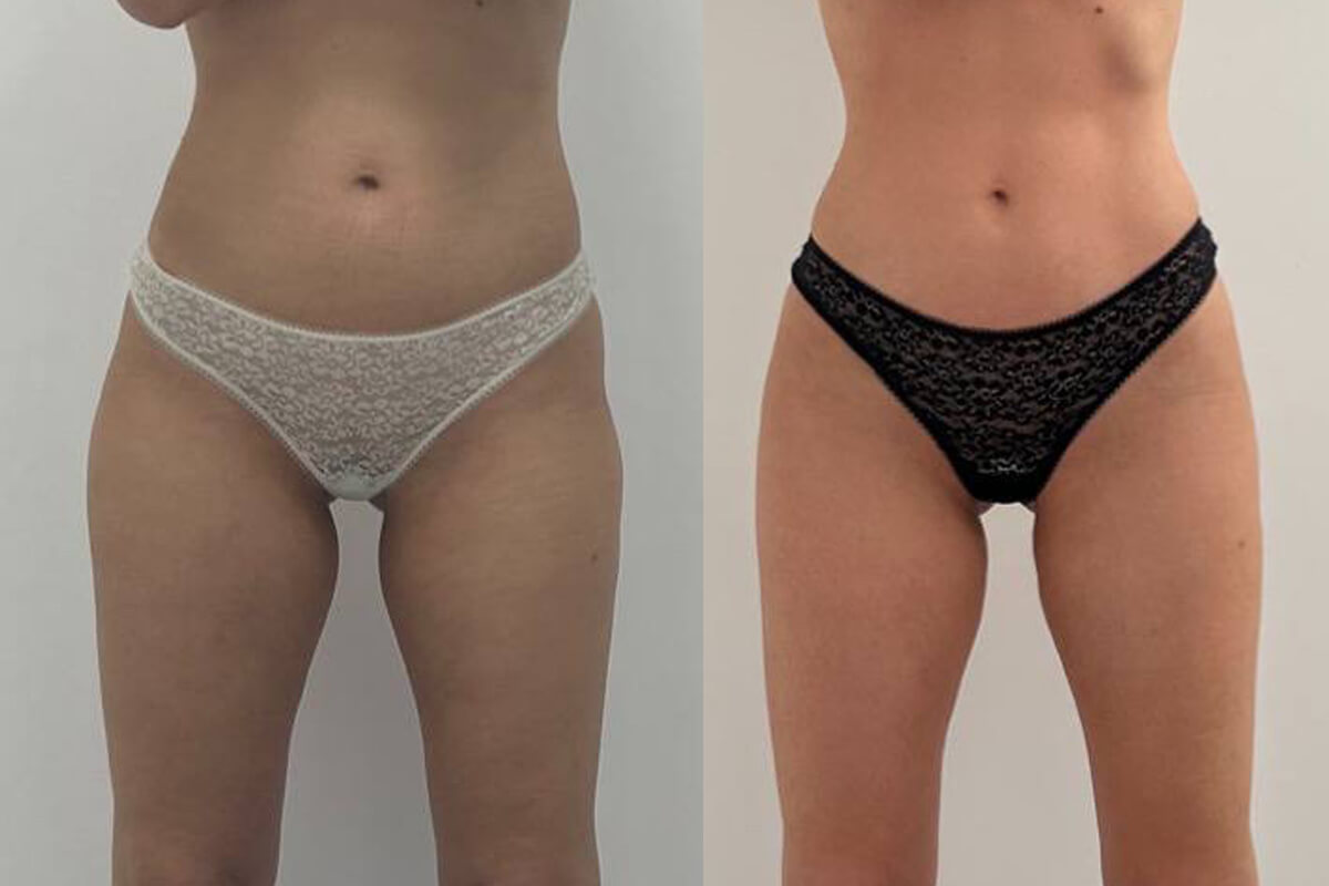 Аппарат EVOLVE 01