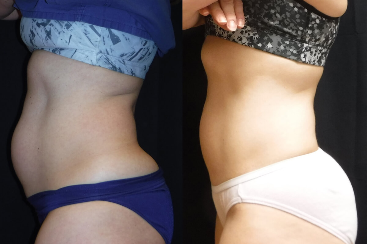 Аппарат EVOLVE 01