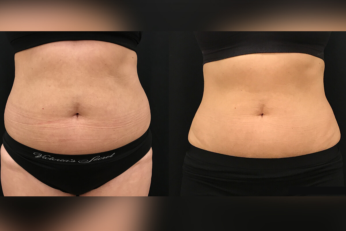 Аппарат EVOLVE 01