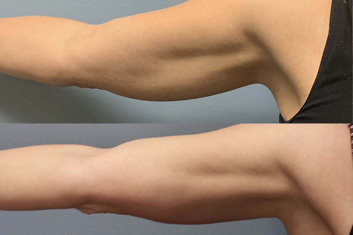 Аппарат EVOLVE 01