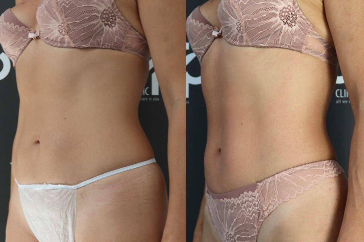 Аппарат EVOLVE 01