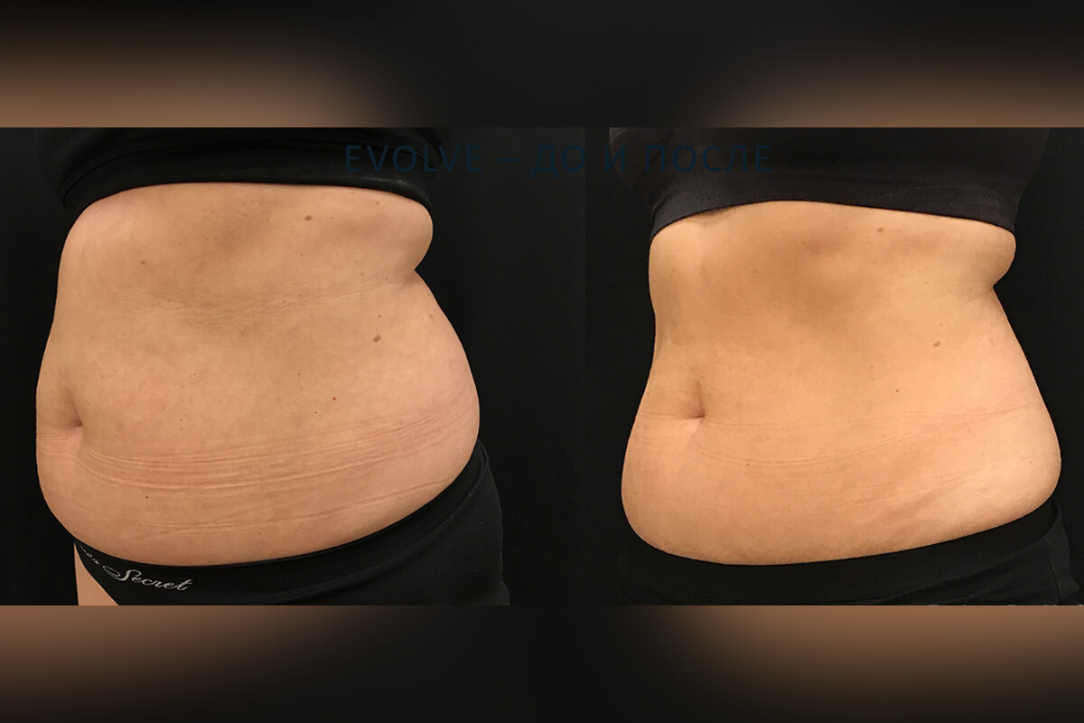 Аппарат EVOLVE 01