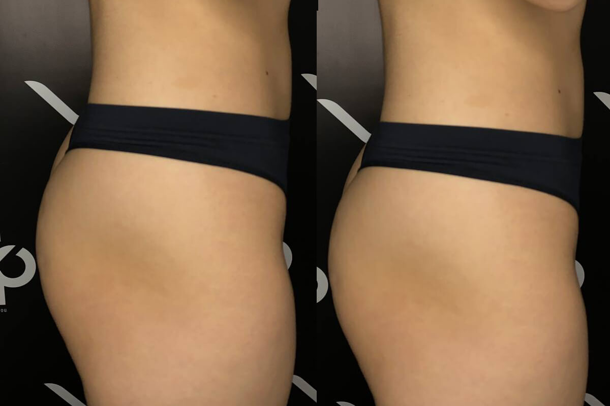 Аппарат EVOLVE 01