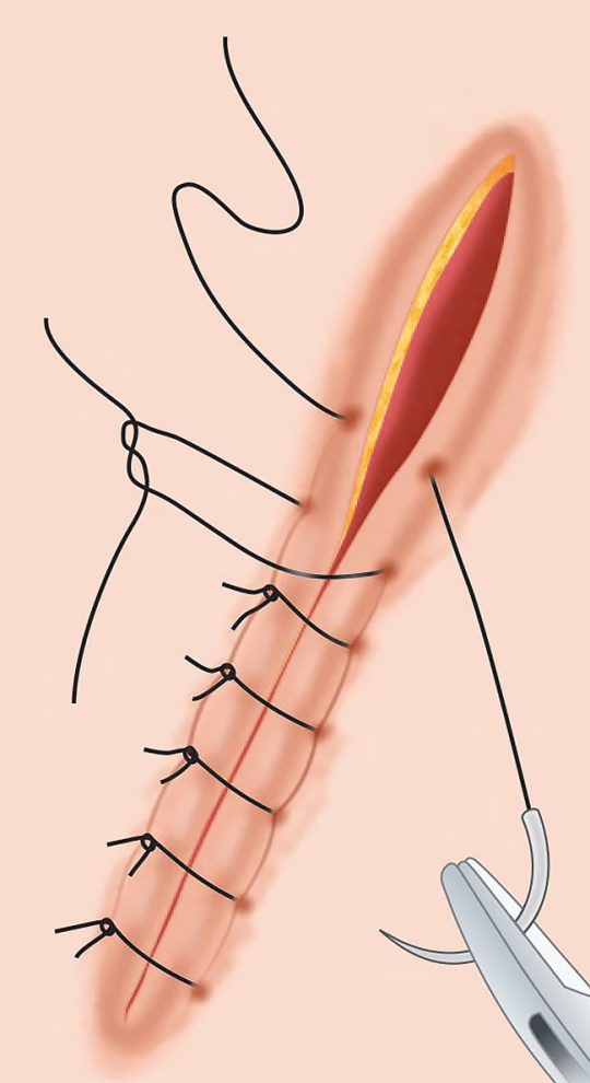 Хирургическое иссечение рубца