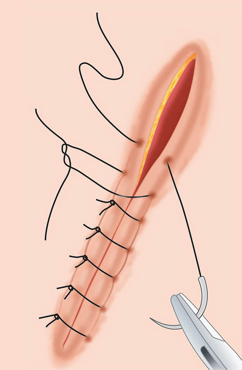 Хирургическое иссечение рубца
