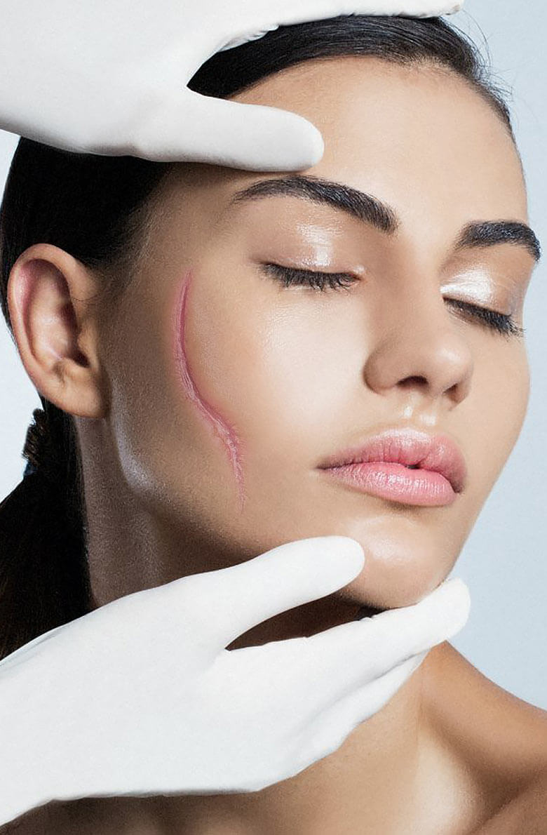 Коррекция рубцов на аппарате PicoSure