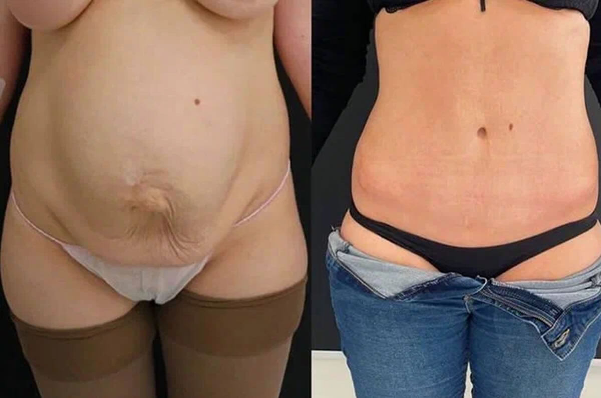 Абдоминопластика с липосакцией 01