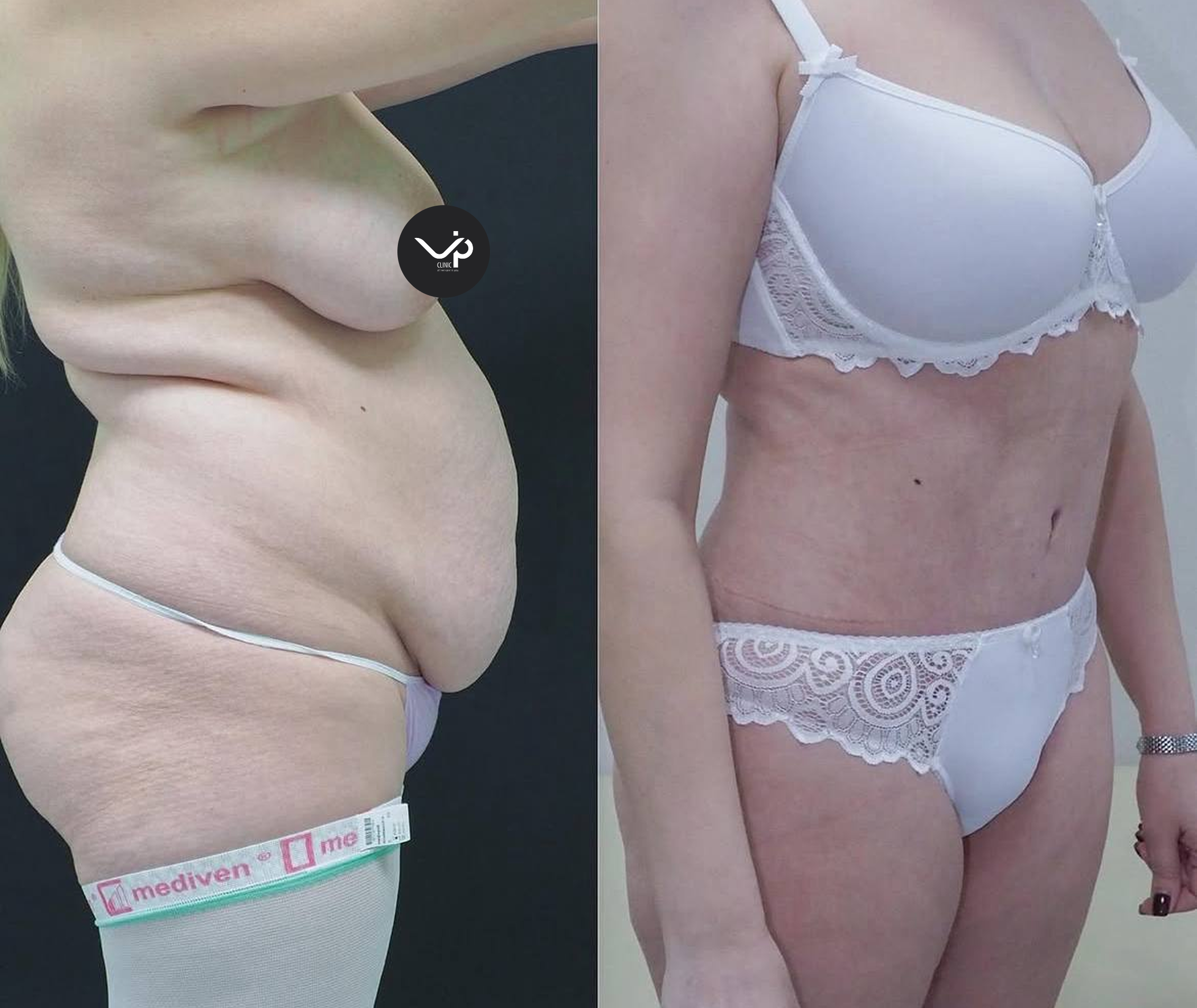 Абдоминопластика с липосакцией 01