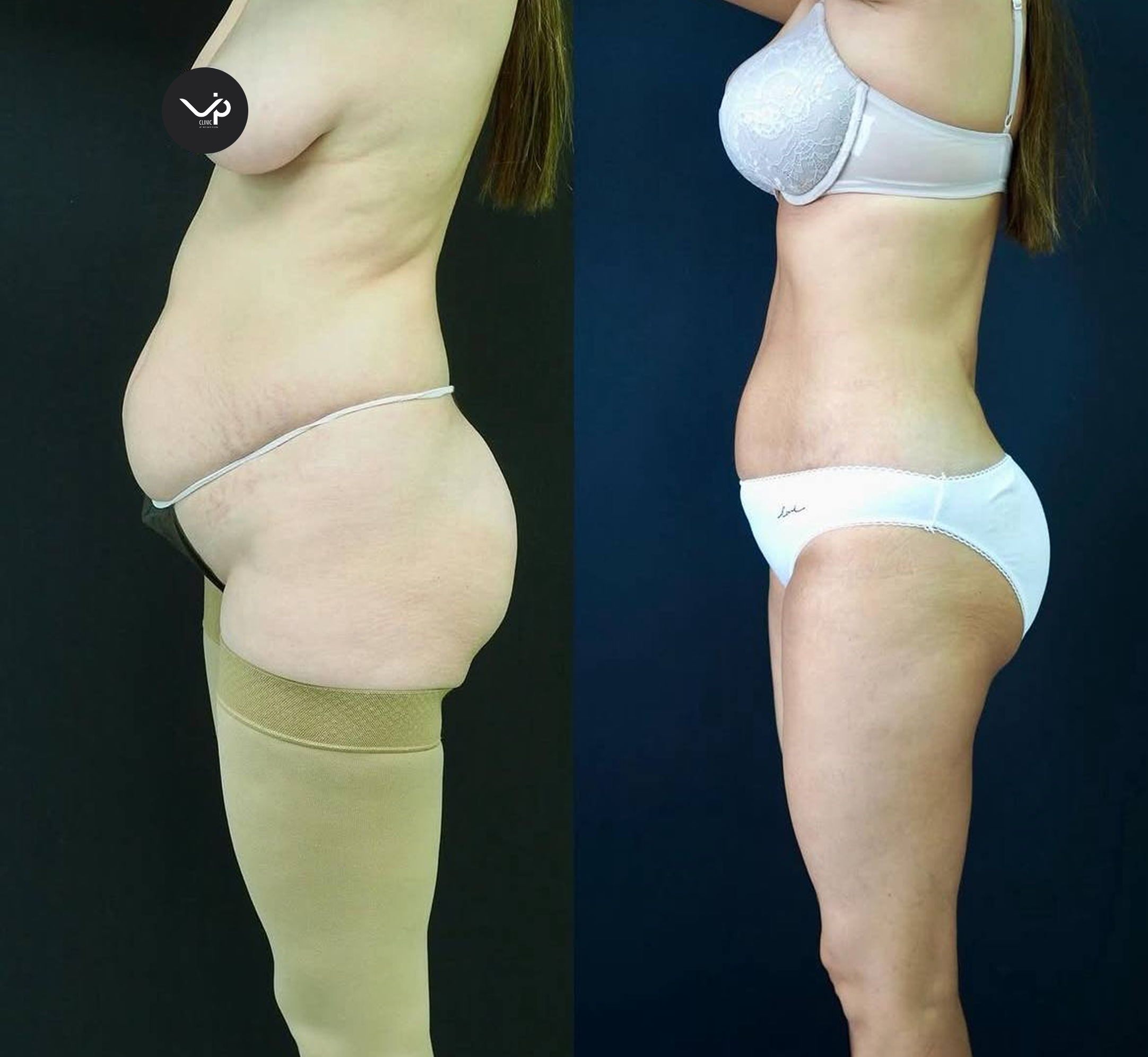 Липофилинг ягодиц 01