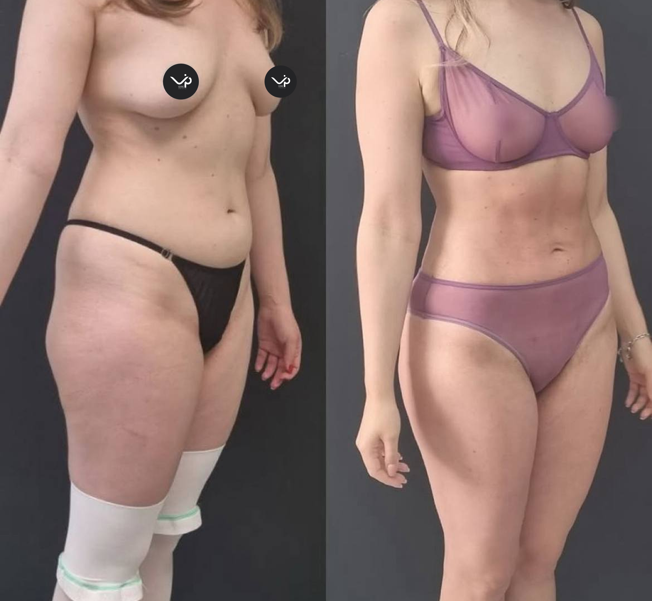 Абдоминопластика с липосакцией 01