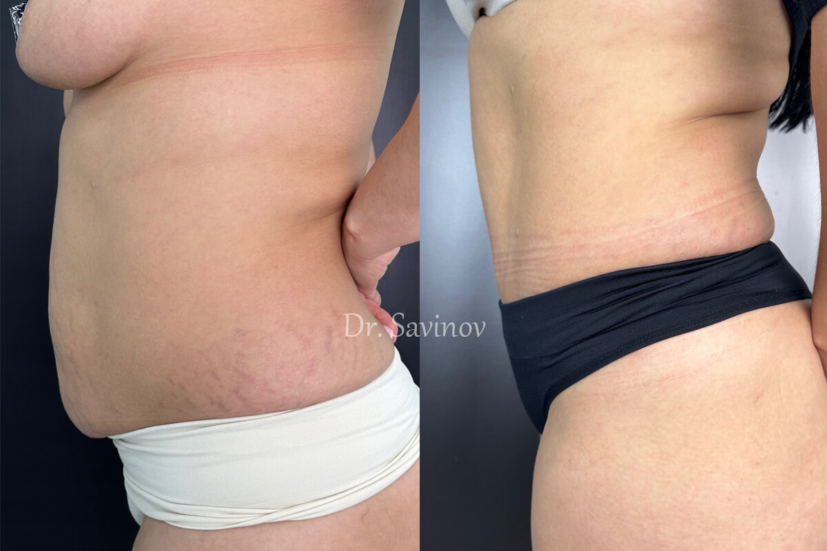 Ушивание диастаза 01