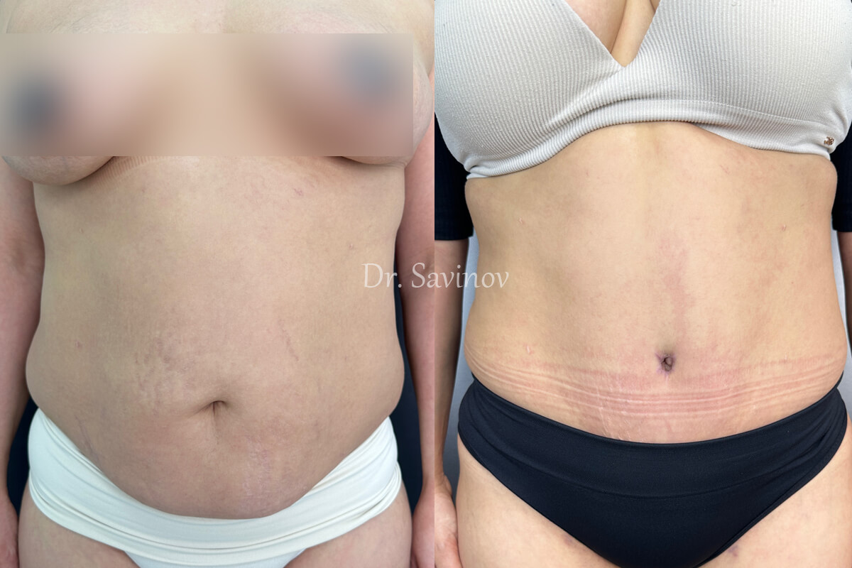 Ушивание диастаза 01