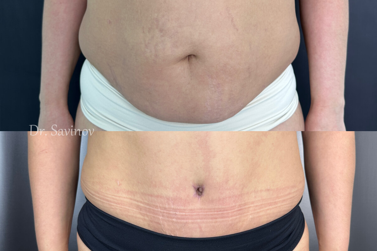 Ушивание диастаза 01