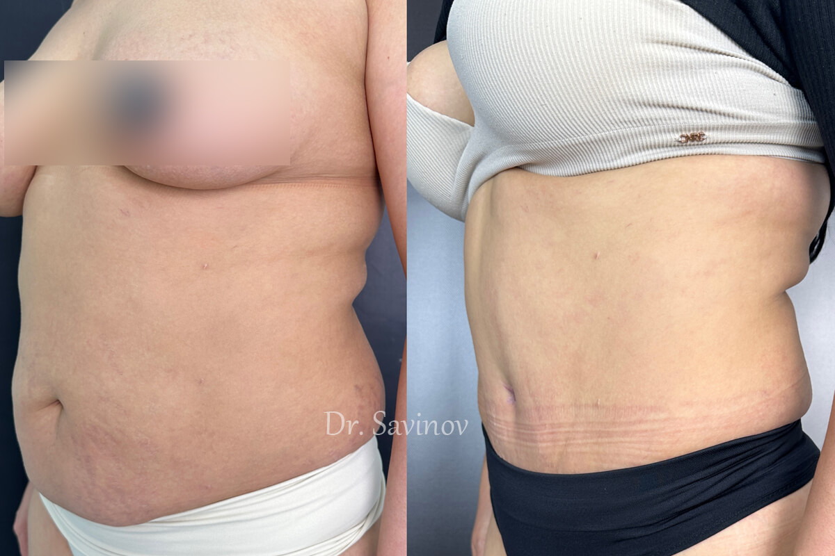 Ушивание диастаза 01