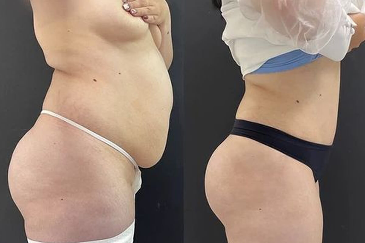 Ушивание диастаза 01