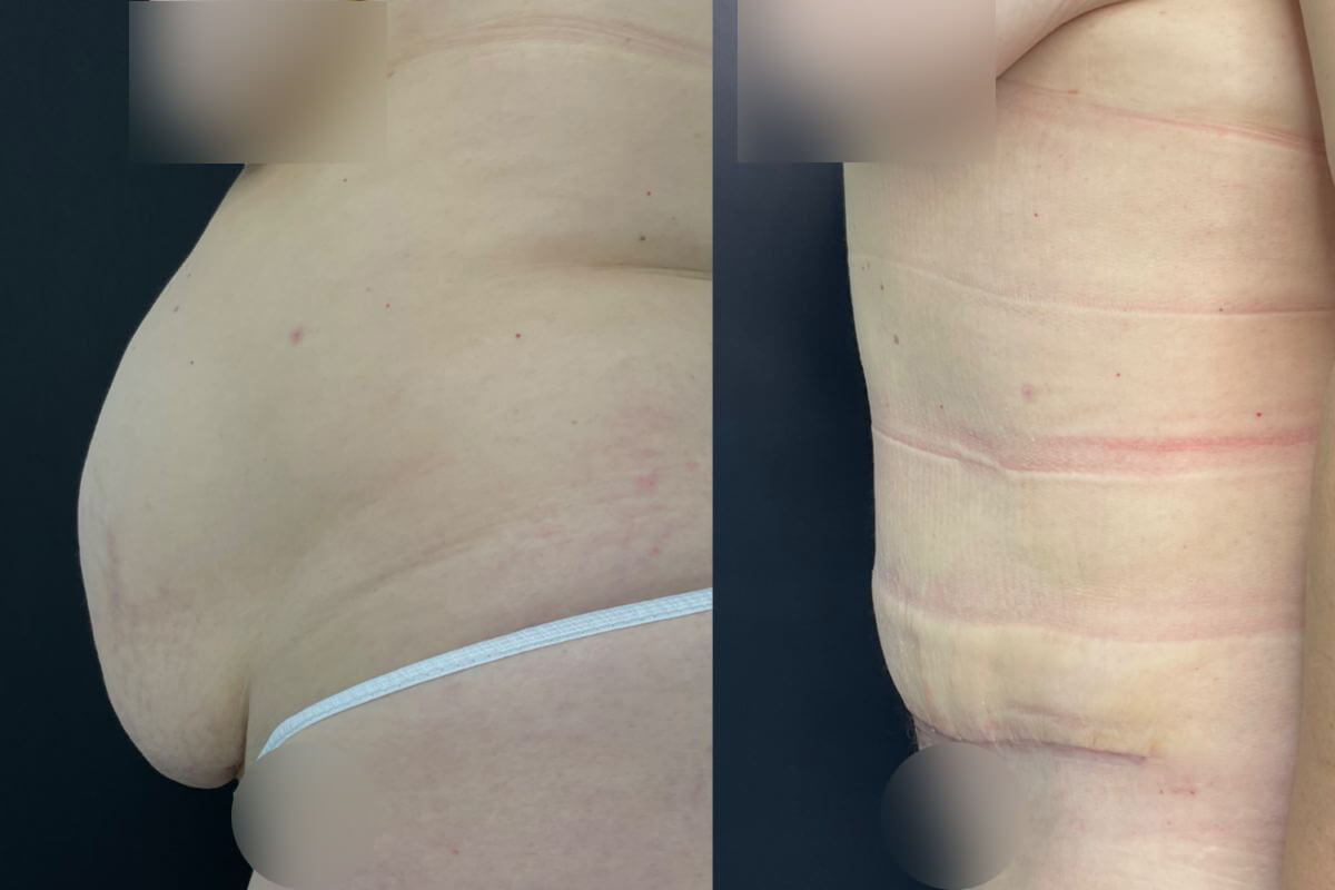 Абдоминопластика с липосакцией 01