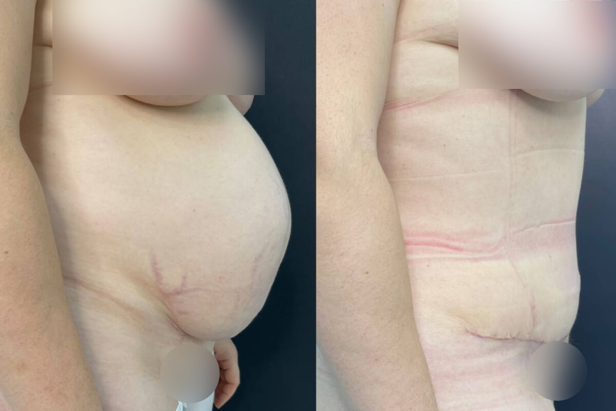 Абдоминопластика с липосакцией 01